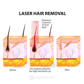 laser hair removal